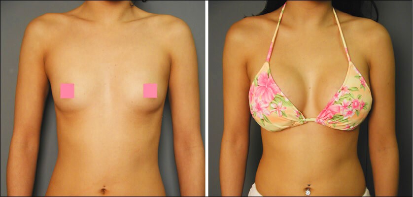 How Can I Guarantee a C Cup After Breast Lift With Augmentation?